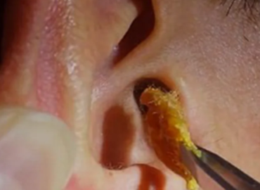 Chelsfield Ear Wax Removal