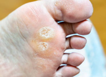 Chelsfield Fungal Skin Infections